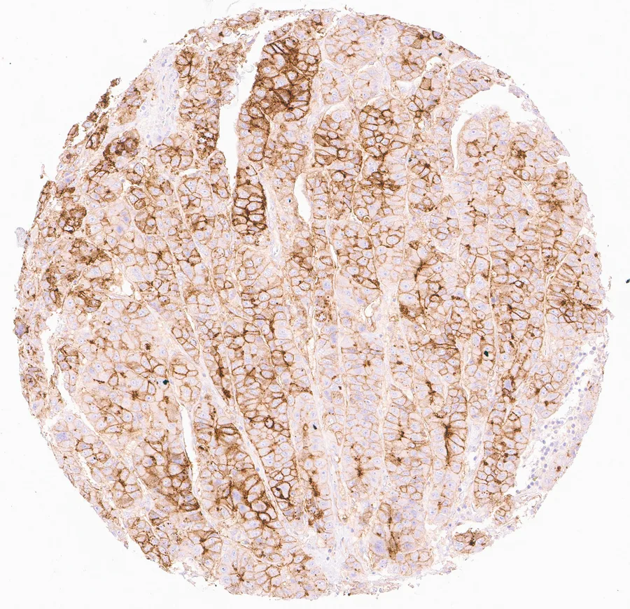 Immunohistochemistry of human CD73 (NT5E) with anti-CD73 clone KK3 (DIA-KK3) in FFPE tissue – membranous CD73 positivity with a heterogeneous pattern in a hepatocellular carcinoma of the liver; figure 02 of the previous ONCOdianova CD73 gallery.