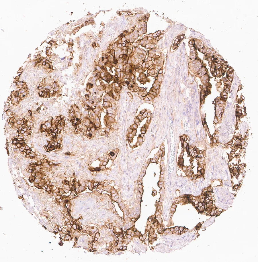 Immunohistochemistry of human CD73 (NT5E) with anti-CD73 clone KK3 (DIA-KK3) in FFPE tissue – membranous CD73 immunostaining with apical predominance in an adenocarcinoma of the lung; figure 04 of the previous ONCOdianova CD73 gallery.