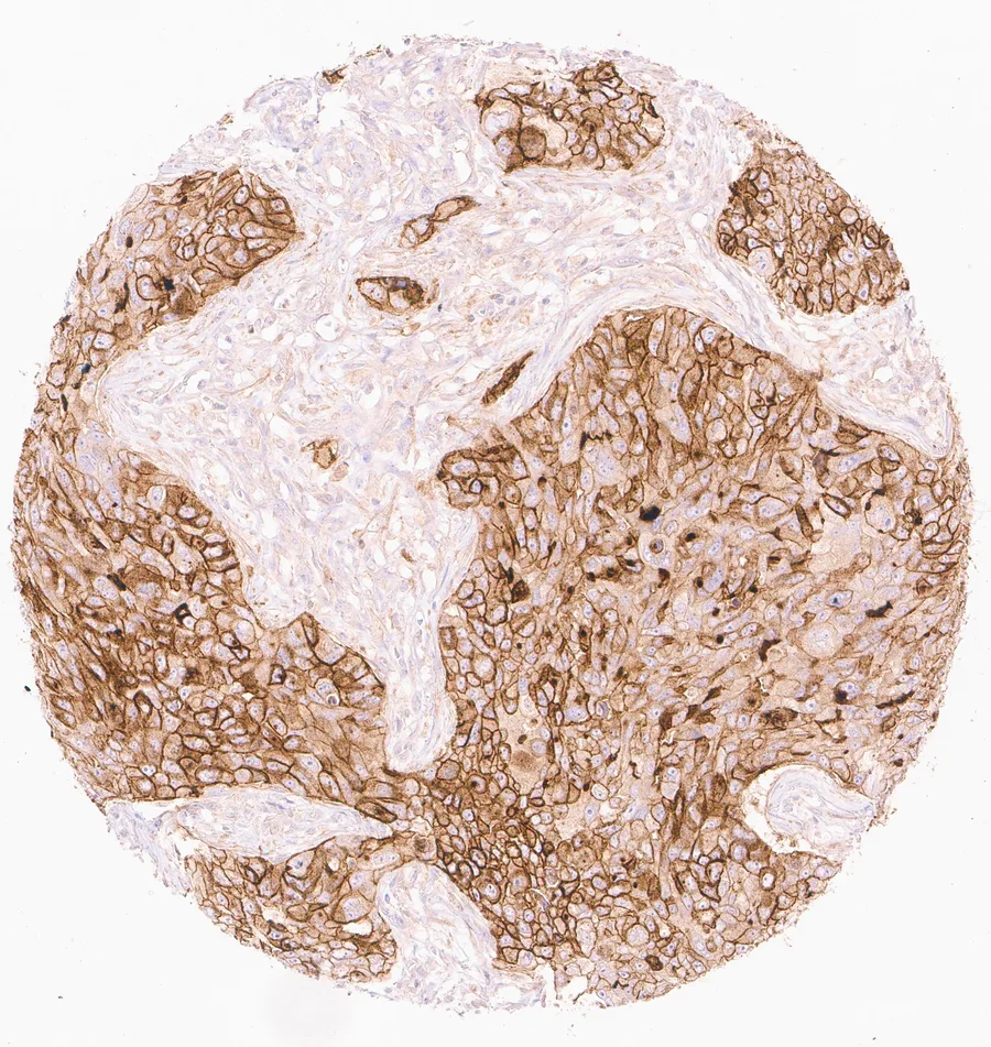 Immunohistochemistry of human CD73 (NT5E) with anti-CD73 clone KK3 (DIA-KK3) in FFPE tissue – strong diffuse CD73 positivity in a squamous cell carcinoma of the lung; figure 05 of the previous ONCOdianova CD73 gallery.
