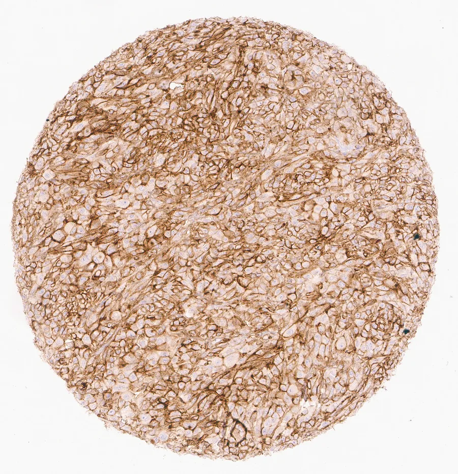 Immunohistochemistry of human CD73 (NT5E) with anti-CD73 clone KK3 (DIA-KK3) in FFPE tissue – prominent membranous CD73 positivity in a malignant melanoma; figure 03 of the previous ONCOdianova CD73 gallery.