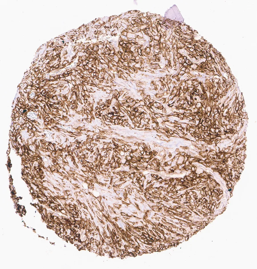 Immunohistochemistry of human CD73 (NT5E) with anti-CD73 clone KK3 (DIA-KK3) in FFPE tissue – CD73 immunostaining in a mixed tumor of the lung; figure 06 of the previous ONCOdianova CD73 gallery.