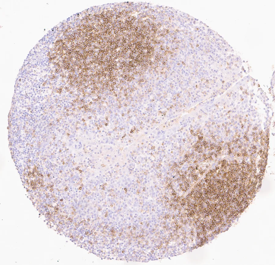 Immunohistochemistry of human CD73 (NT5E) with anti-CD73 clone KK3 (DIA-KK3) in FFPE tissue – CD73 immunostaining in tonsil, the positive-control tissue named in the datasheet; figure 07 of the previous ONCOdianova CD73 gallery.
