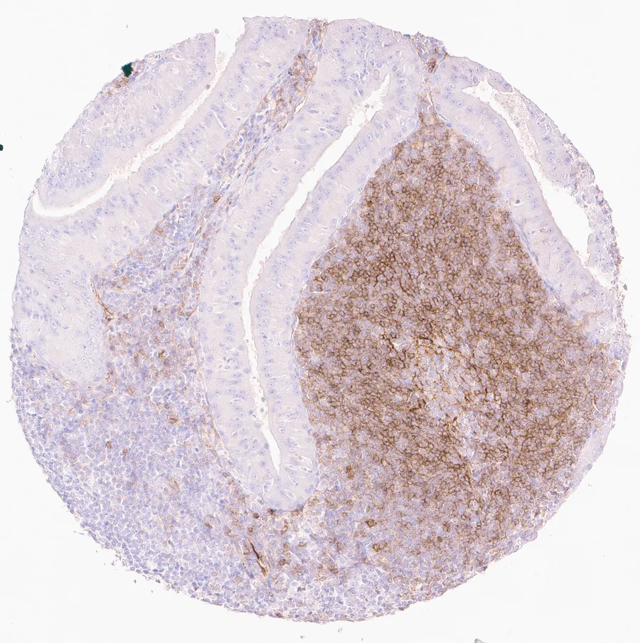 Immunohistochemistry of human CD73 (NT5E) with anti-CD73 clone KK3 (DIA-KK3) in FFPE tissue – distinct CD73 staining in lymphocytes in a Warthin tumor of the parotid gland; figure 10 of the previous ONCOdianova CD73 gallery.