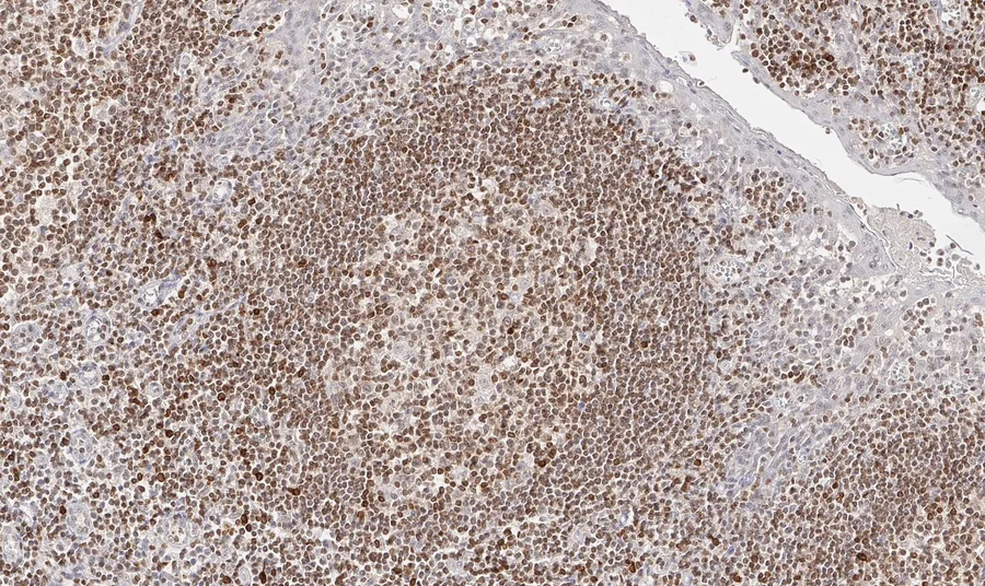Immunohistochemistry of human CD112R/PVRIG with anti-CD112R/PVRIG clone R12 (DIA-R12) in FFPE tissue – brightfield IHC, figure 04 of the previous ONCOdianova CD112R gallery.