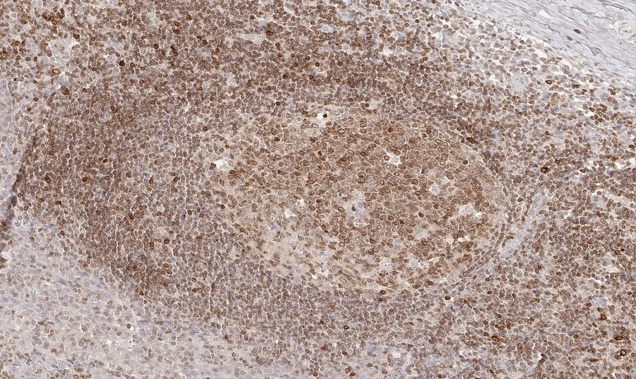 Immunohistochemistry of human CD112R/PVRIG with anti-CD112R/PVRIG clone R12 (DIA-R12) in FFPE tissue – brightfield IHC, figure 05 of the previous ONCOdianova CD112R gallery.