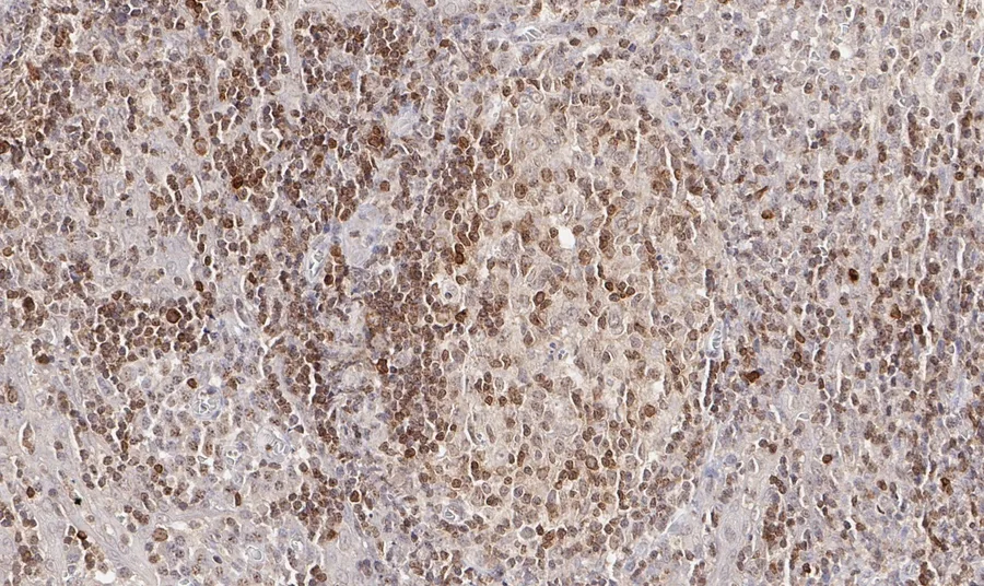 Immunohistochemistry of human CD112R/PVRIG with anti-CD112R/PVRIG clone R12 (DIA-R12) in FFPE tissue – brightfield IHC, figure 07 of the previous ONCOdianova CD112R gallery.