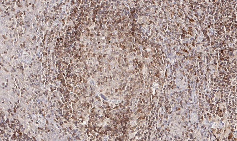 Immunohistochemistry of human CD112R/PVRIG with anti-CD112R/PVRIG clone R12 (DIA-R12) in FFPE tissue – brightfield IHC, figure 08 of the previous ONCOdianova CD112R gallery.