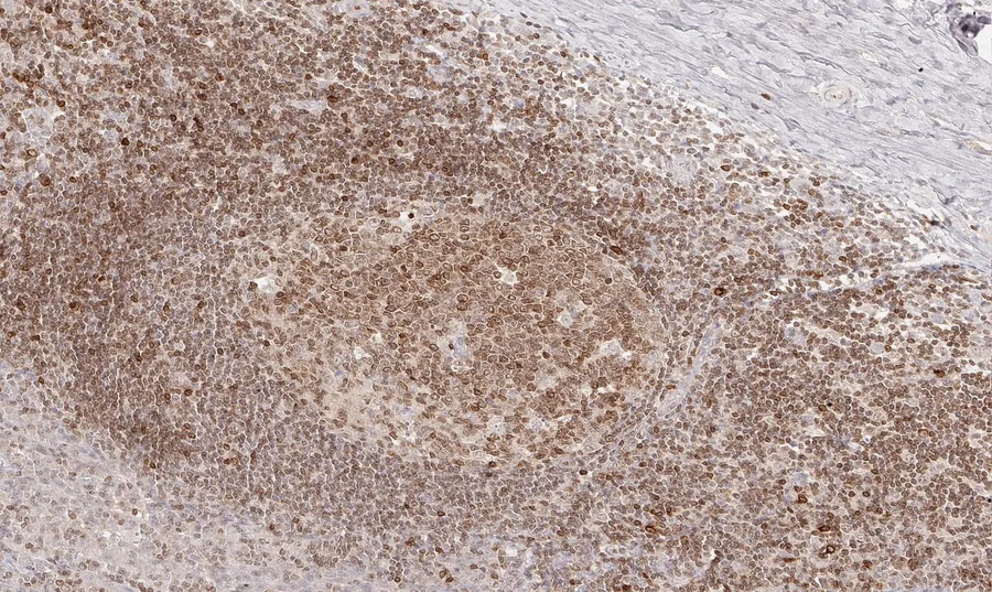 Immunohistochemistry of human CD112R/PVRIG with anti-CD112R/PVRIG clone R12 (DIA-R12) in FFPE tissue – brightfield IHC, figure 09 of the previous ONCOdianova CD112R gallery.