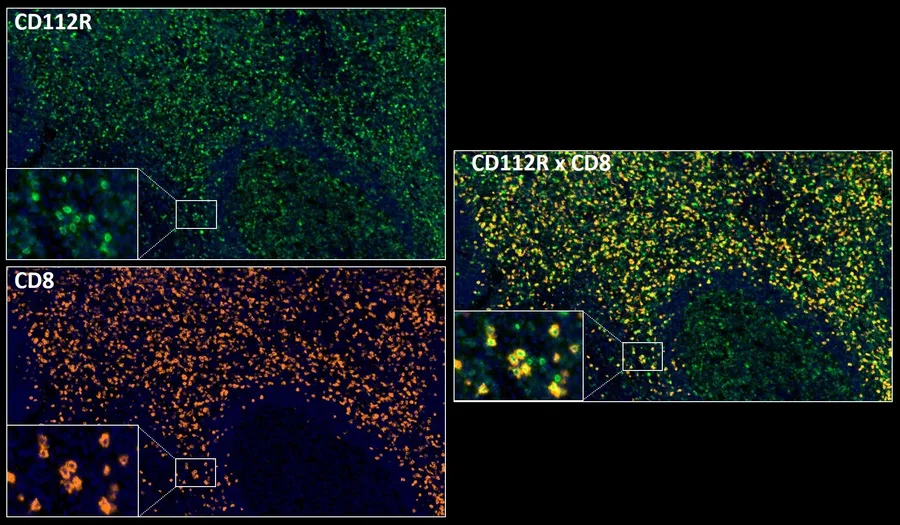 Fluorescence multiplex immunohistochemistry of CD112R/PVRIG (clone R12, DIA-R12; green) and CD8 (orange) in human FFPE tissue – single channels CD112R (green) and CD8 (orange) with detail insets, and overlay CD112R × CD8; figure 02 of the previous ONCOdianova CD112R gallery.