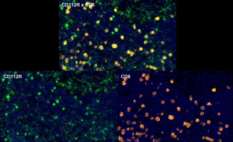 Fluorescence multiplex immunohistochemistry of CD112R/PVRIG (clone R12, DIA-R12; green) and CD8 (orange) in human FFPE tissue – overlay CD112R × CD8 (top) and single channels CD112R and CD8 (bottom), higher magnification; figure 10 of the previous ONCOdianova CD112R gallery.
