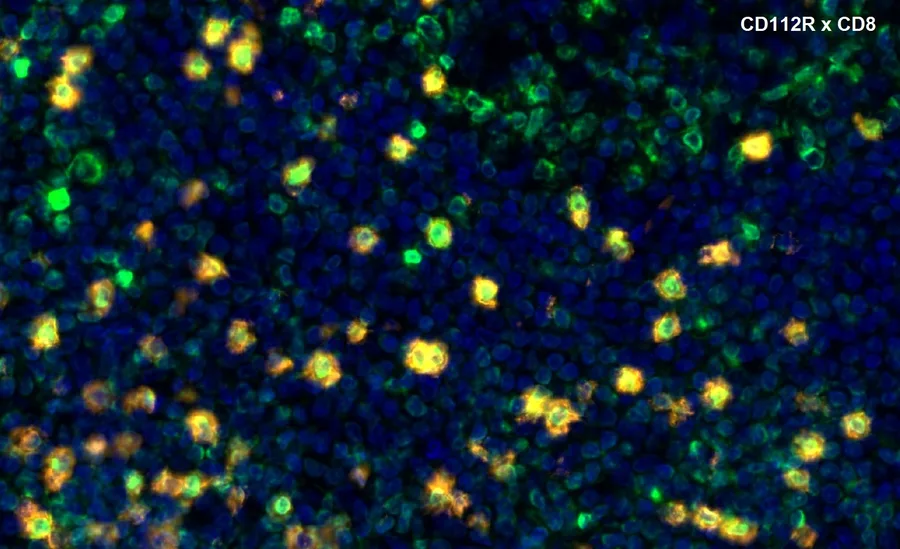 Fluorescence multiplex immunohistochemistry of CD112R/PVRIG (clone R12, DIA-R12; green) and CD8 (orange) in human FFPE tissue – overlay CD112R × CD8, higher magnification; double-positive cells appear yellow; figure 11 of the previous ONCOdianova CD112R gallery.