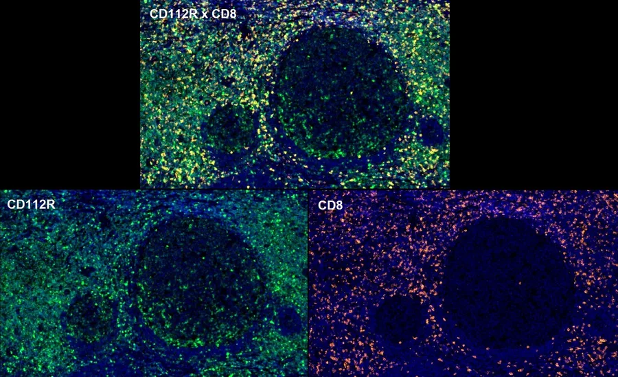 Fluorescence multiplex immunohistochemistry of CD112R/PVRIG (clone R12, DIA-R12; green) and CD8 (orange) in human FFPE tissue – overlay CD112R × CD8 (top) and single channels CD112R and CD8 (bottom) around lymphoid follicles; figure 12 of the previous ONCOdianova CD112R gallery.