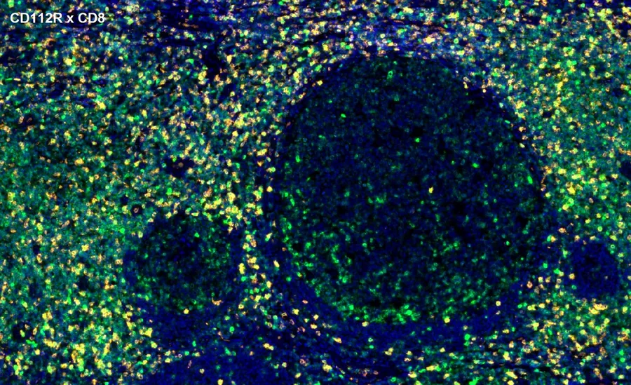 Fluorescence multiplex immunohistochemistry of CD112R/PVRIG (clone R12, DIA-R12; green) and CD8 (orange) in human FFPE tissue – overlay CD112R × CD8 around lymphoid follicles, overview; figure 13 of the previous ONCOdianova CD112R gallery.