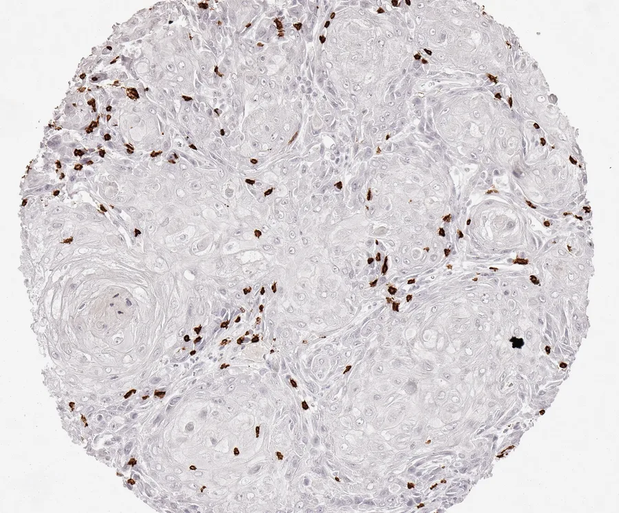 Immunohistochemistry of human CD8 with anti-CD8 clone TC8 (DIA-TC8) in FFPE tissue – scattered CD8-positive lymphocytes in anal squamous cell carcinoma; figure 29 of the previous ONCOdianova CD8 gallery.