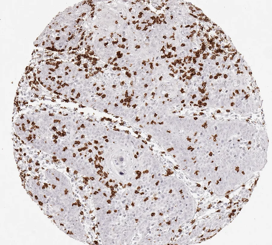 Immunohistochemistry of human CD8 with anti-CD8 clone TC8 (DIA-TC8) in FFPE tissue – scattered CD8-positive lymphocytes in anal squamous cell carcinoma; figure 30 of the previous ONCOdianova CD8 gallery.