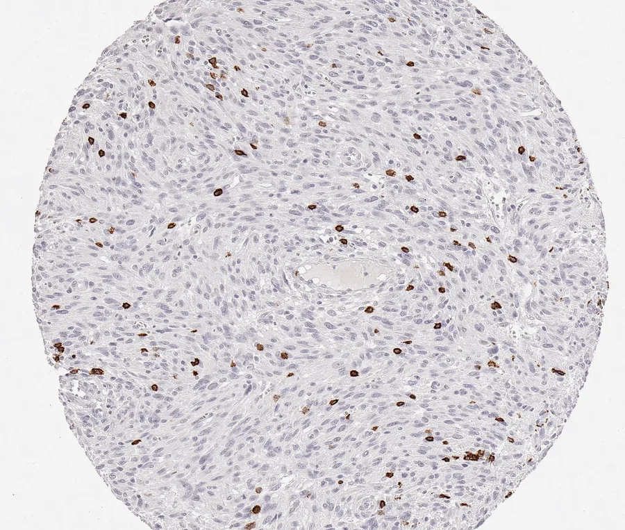 Immunohistochemistry of human CD8 with anti-CD8 clone TC8 (DIA-TC8) in FFPE tissue – CD8-positive lymphocytes in anal squamous cell carcinoma; figure 31 of the previous ONCOdianova CD8 gallery (tissue designation from the source file name).