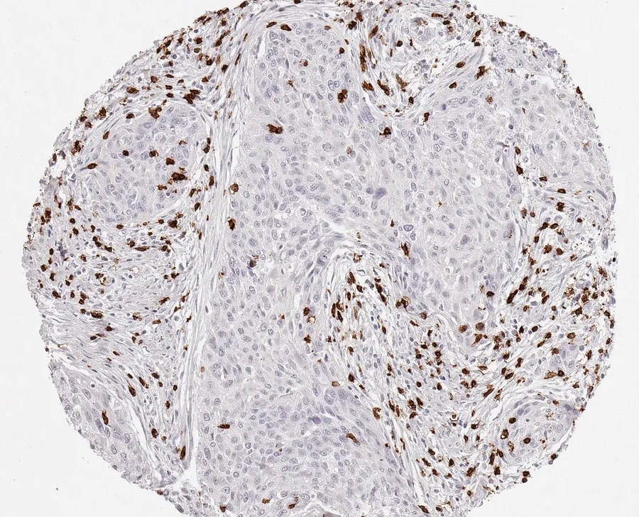 Immunohistochemistry of human CD8 with anti-CD8 clone TC8 (DIA-TC8) in FFPE tissue – CD8-positive lymphocytes, in this case predominantly located in the cancer stroma in squamous cell carcinoma of the cervix uteri; figure 14 of the previous ONCOdianova CD8 gallery.