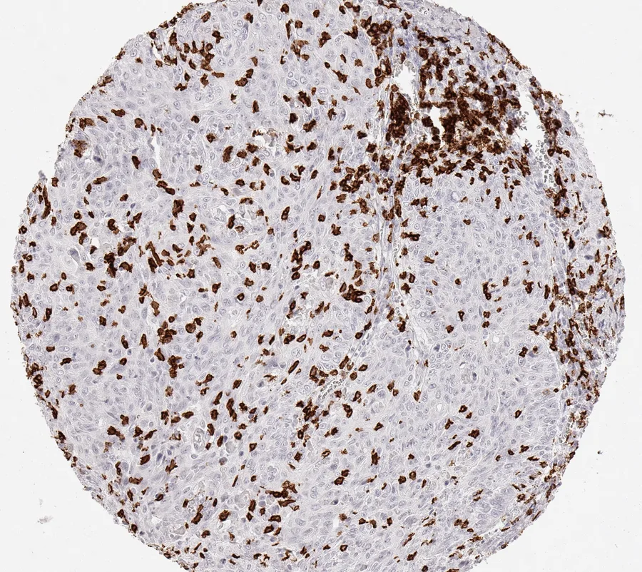 Immunohistochemistry of human CD8 with anti-CD8 clone TC8 (DIA-TC8) in FFPE tissue – CD8-positive lymphocytes, in this case located both in the cancer stroma and within cancer cell nests in squamous cell carcinoma of the cervix uteri; figure 15 of the previous ONCOdianova CD8 gallery.