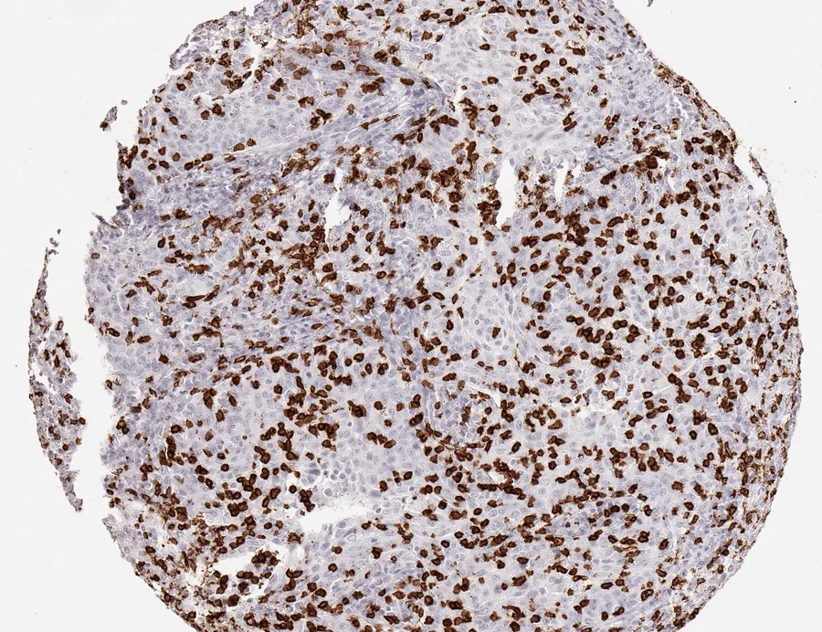 Immunohistochemistry of human CD8 with anti-CD8 clone TC8 (DIA-TC8) in FFPE tissue – very dense lymphocytic infiltration in squamous cell carcinoma of the cervix uteri; figure 16 of the previous ONCOdianova CD8 gallery.