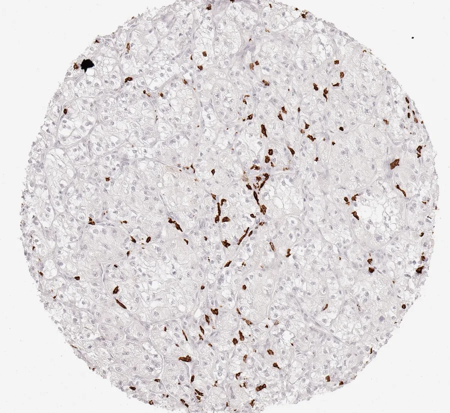 Immunohistochemistry of human CD8 with anti-CD8 clone TC8 (DIA-TC8) in FFPE tissue – moderately dense infiltration by CD8-positive lymphocytes in clear cell kidney cancer; figure 20 of the previous ONCOdianova CD8 gallery.