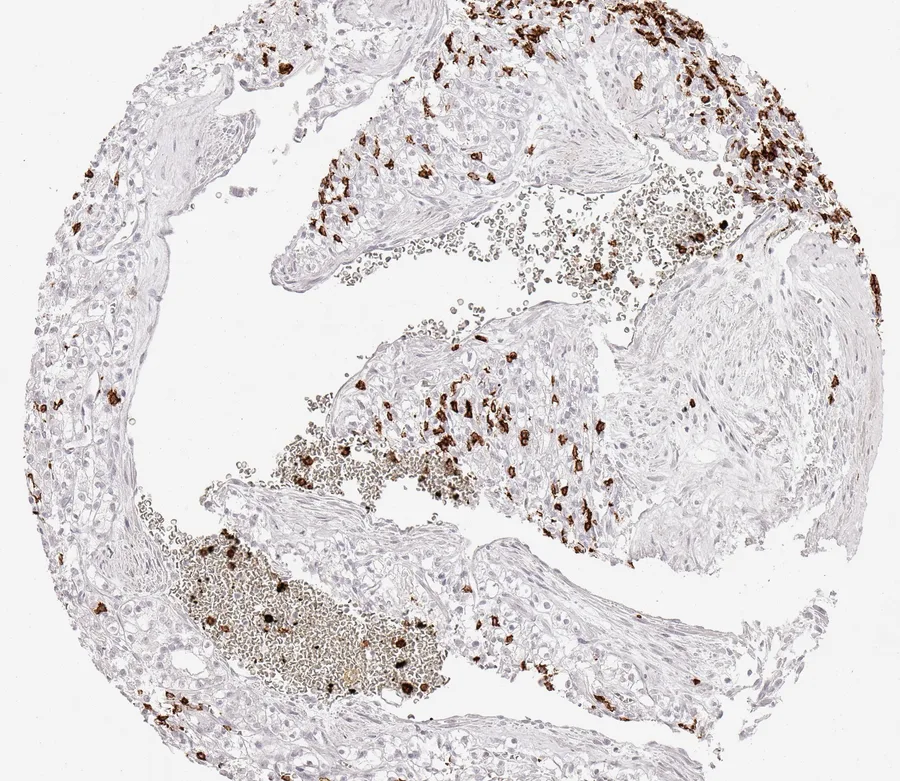 Immunohistochemistry of human CD8 with anti-CD8 clone TC8 (DIA-TC8) in FFPE tissue – only few scattered CD8-positive lymphocytes in clear cell kidney cancer; figure 22 of the previous ONCOdianova CD8 gallery.