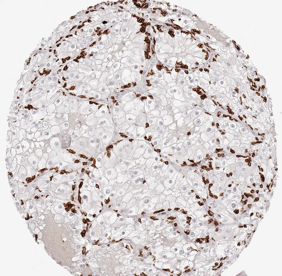 Immunohistochemistry of human CD8 with anti-CD8 clone TC8 (DIA-TC8) in FFPE tissue – high number of CD8-positive lymphocytes, regularly arranged at the periphery of tumour cell sheets in clear cell kidney cancer; figure 23 of the previous ONCOdianova CD8 gallery.