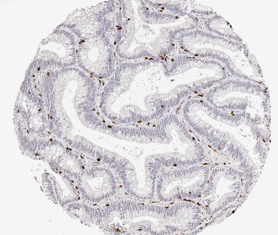 Immunohistochemistry of human CD8 with anti-CD8 clone TC8 (DIA-TC8) in FFPE tissue – CD8-positive lymphocytes in colon adenoma; figure 27 of the previous ONCOdianova CD8 gallery (tissue designation from the source file name).
