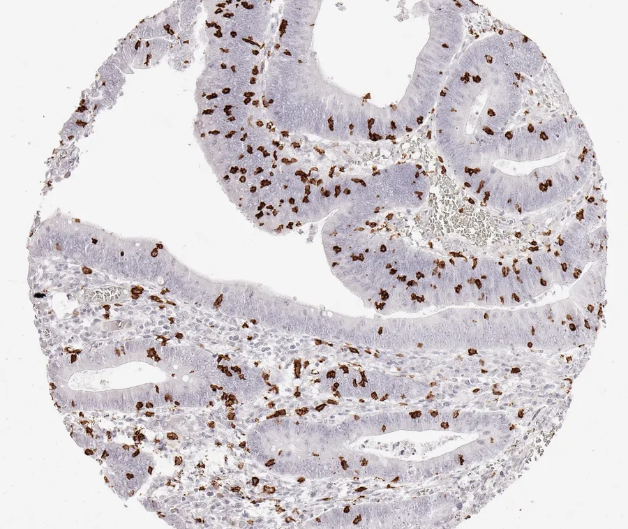 Immunohistochemistry of human CD8 with anti-CD8 clone TC8 (DIA-TC8) in FFPE tissue – CD8-positive lymphocytes in colon adenoma; figure 28 of the previous ONCOdianova CD8 gallery (tissue designation from the source file name).
