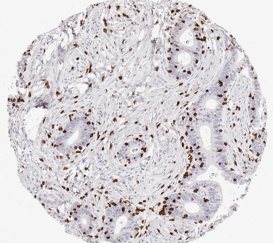 Immunohistochemistry of human CD8 with anti-CD8 clone TC8 (DIA-TC8) in FFPE tissue – CD8-positive lymphocytes in endometrioid ovarian cancer; figure 11 of the previous ONCOdianova CD8 gallery.