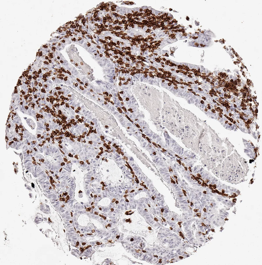 Immunohistochemistry of human CD8 with anti-CD8 clone TC8 (DIA-TC8) in FFPE tissue – dense infiltrate of CD8-positive lymphocytes in adenocarcinoma of the oesophagus; figure 05 of the previous ONCOdianova CD8 gallery.