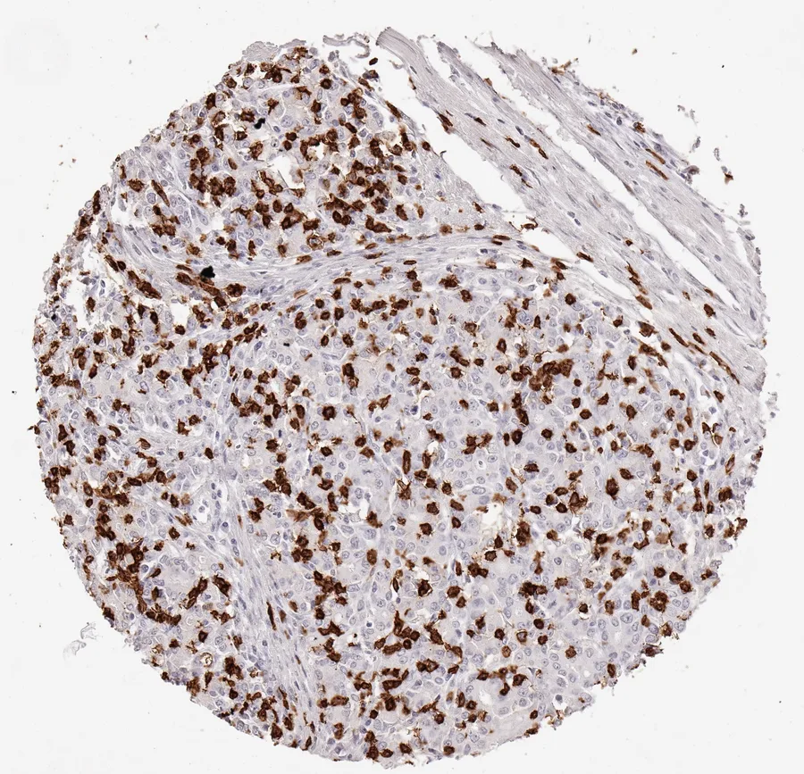 Immunohistochemistry of human CD8 with anti-CD8 clone TC8 (DIA-TC8) in FFPE tissue – very high density of CD8-positive lymphocytes in adenocarcinoma of the oesophagus; figure 06 of the previous ONCOdianova CD8 gallery.