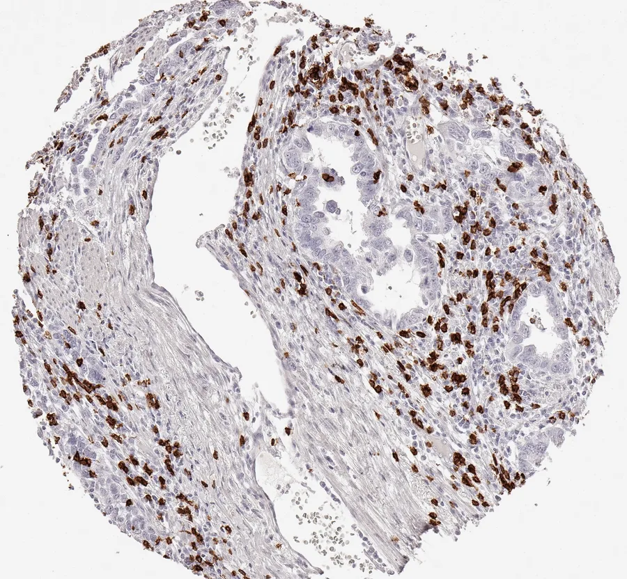 Immunohistochemistry of human CD8 with anti-CD8 clone TC8 (DIA-TC8) in FFPE tissue – CD8-positive lymphocytes predominantly located in the tumour stroma in adenocarcinoma of the oesophagus; figure 07 of the previous ONCOdianova CD8 gallery.