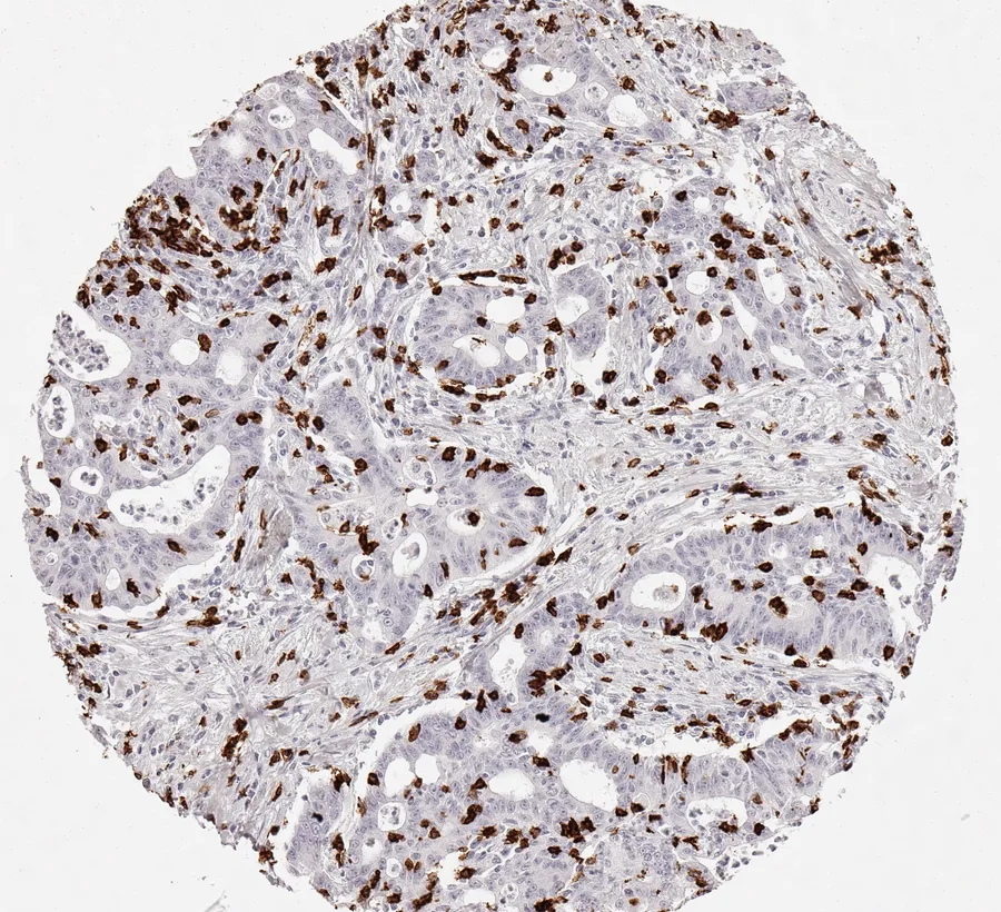 Immunohistochemistry of human CD8 with anti-CD8 clone TC8 (DIA-TC8) in FFPE tissue – moderately dense infiltration by CD8-positive cells in intestinal-type gastric cancer; figure 08 of the previous ONCOdianova CD8 gallery.