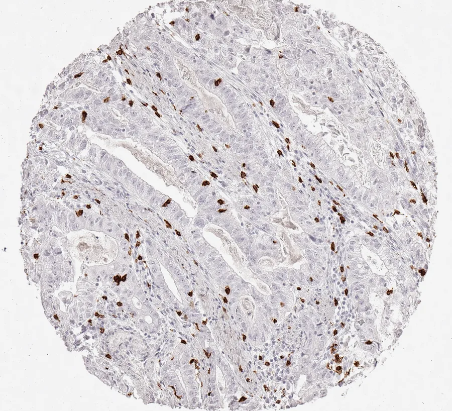 Immunohistochemistry of human CD8 with anti-CD8 clone TC8 (DIA-TC8) in FFPE tissue – relatively few CD8-positive cells in intestinal-type gastric cancer; figure 09 of the previous ONCOdianova CD8 gallery.