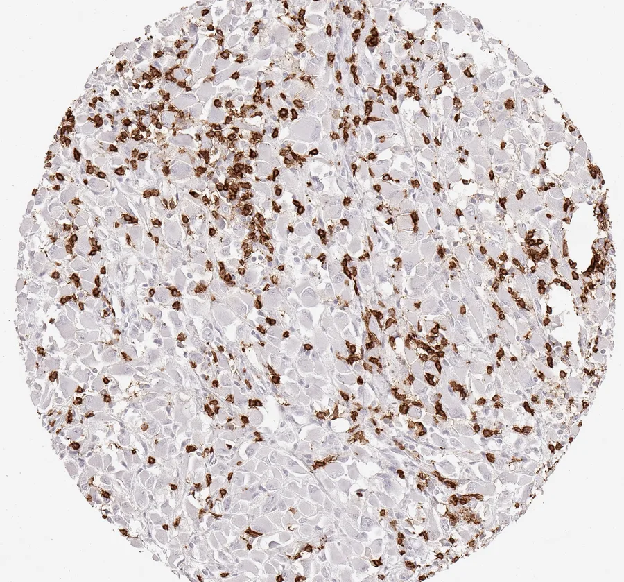 Immunohistochemistry of human CD8 with anti-CD8 clone TC8 (DIA-TC8) in FFPE tissue – CD8-positive lymphocytes in kidney cancer; figure 21 of the previous ONCOdianova CD8 gallery (tissue designation from the source file name).
