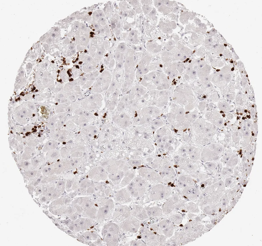 Immunohistochemistry of human CD8 with anti-CD8 clone TC8 (DIA-TC8) in FFPE tissue – CD8-positive lymphocytes, moderate density in liver cell cancer; figure 26 of the previous ONCOdianova CD8 gallery.