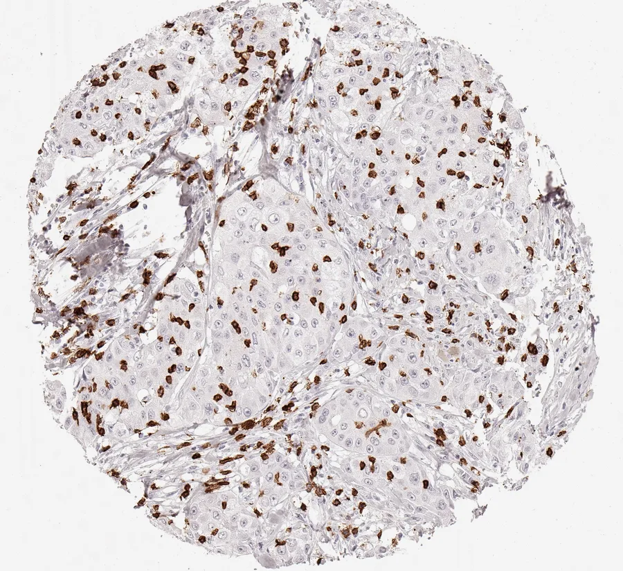 Immunohistochemistry of human CD8 with anti-CD8 clone TC8 (DIA-TC8) in FFPE tissue – marked infiltration by CD8-positive lymphocytes, predominantly located between cancer cells with immediate contact to neoplastic cells in adenocarcinoma of the lung; figure 03 of the previous ONCOdianova CD8 gallery.