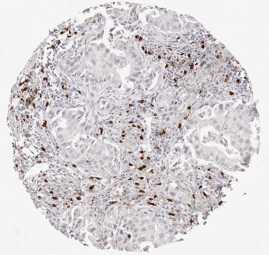 Immunohistochemistry of human CD8 with anti-CD8 clone TC8 (DIA-TC8) in FFPE tissue – marked infiltration by CD8-positive lymphocytes, almost exclusively located in the tumour stroma without immediate contact to neoplastic cells in adenocarcinoma of the lung; figure 04 of the previous ONCOdianova CD8 gallery.