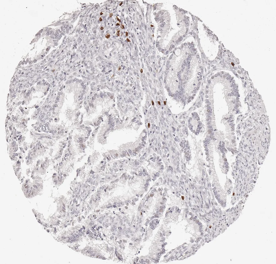 Immunohistochemistry of human CD8 with anti-CD8 clone TC8 (DIA-TC8) in FFPE tissue – only few CD8-positive lymphocytes in mucinous ovarian tumour; figure 10 of the previous ONCOdianova CD8 gallery.