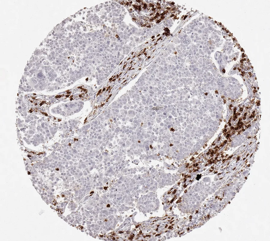Immunohistochemistry of human CD8 with anti-CD8 clone TC8 (DIA-TC8) in FFPE tissue – CD8-positive lymphocytes primarily located in the tumour stroma in neuroendocrine tumour of the pancreas; figure 32 of the previous ONCOdianova CD8 gallery.