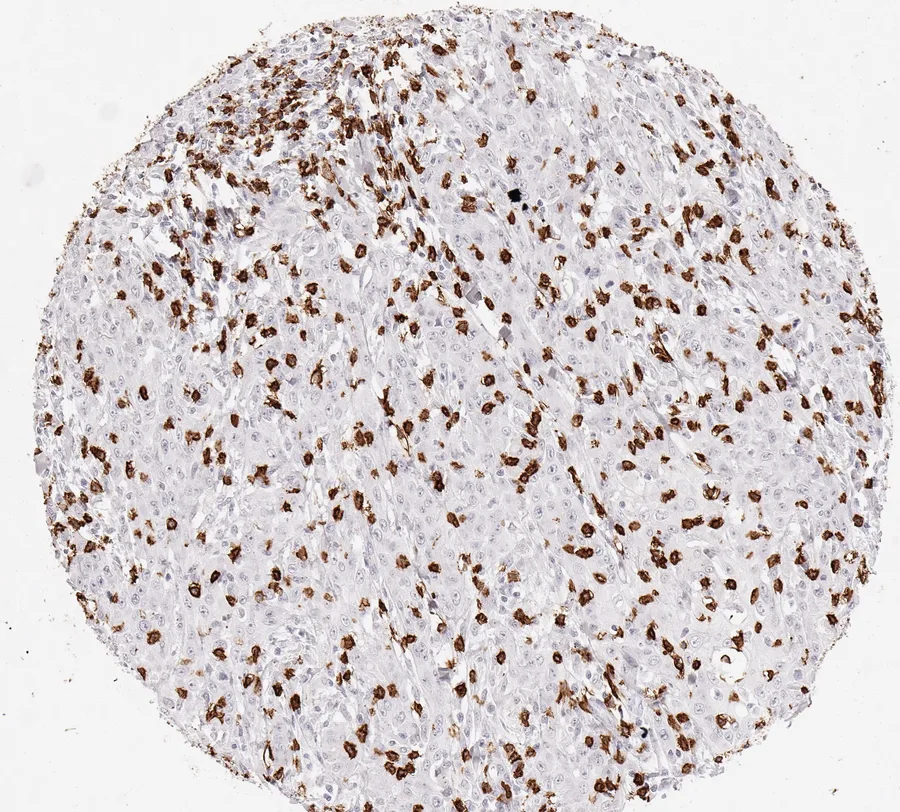 Immunohistochemistry of human CD8 with anti-CD8 clone TC8 (DIA-TC8) in FFPE tissue – CD8-positive lymphocytes in squamous cell carcinoma of the oral cavity; figure 36 of the previous ONCOdianova CD8 gallery.