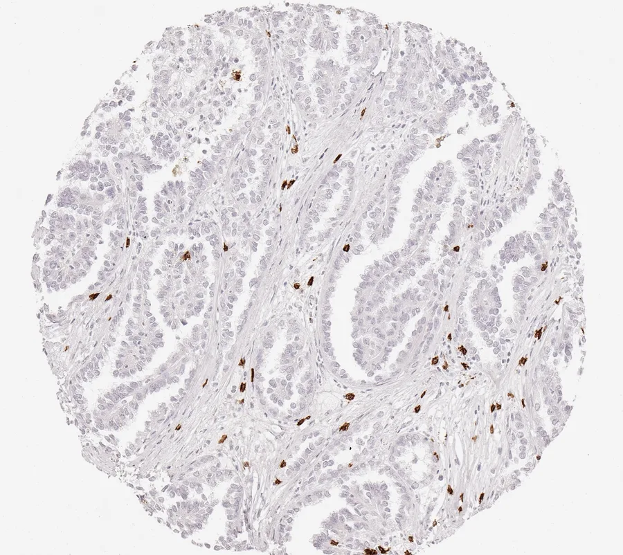 Immunohistochemistry of human CD8 with anti-CD8 clone TC8 (DIA-TC8) in FFPE tissue – few CD8-positive lymphocytes in papillary kidney cancer; figure 19 of the previous ONCOdianova CD8 gallery.
