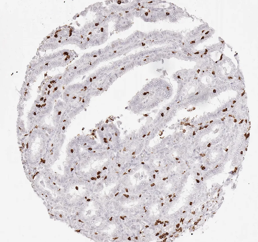 Immunohistochemistry of human CD8 with anti-CD8 clone TC8 (DIA-TC8) in FFPE tissue – CD8-positive lymphocytes in papillary carcinoma of the thyroid; figure 33 of the previous ONCOdianova CD8 gallery.