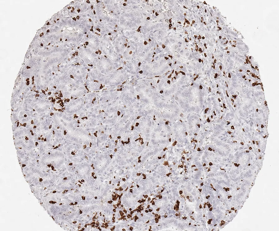 Immunohistochemistry of human CD8 with anti-CD8 clone TC8 (DIA-TC8) in FFPE tissue – dense infiltration by CD8-positive lymphocytes in papillary carcinoma of the thyroid; figure 34 of the previous ONCOdianova CD8 gallery.