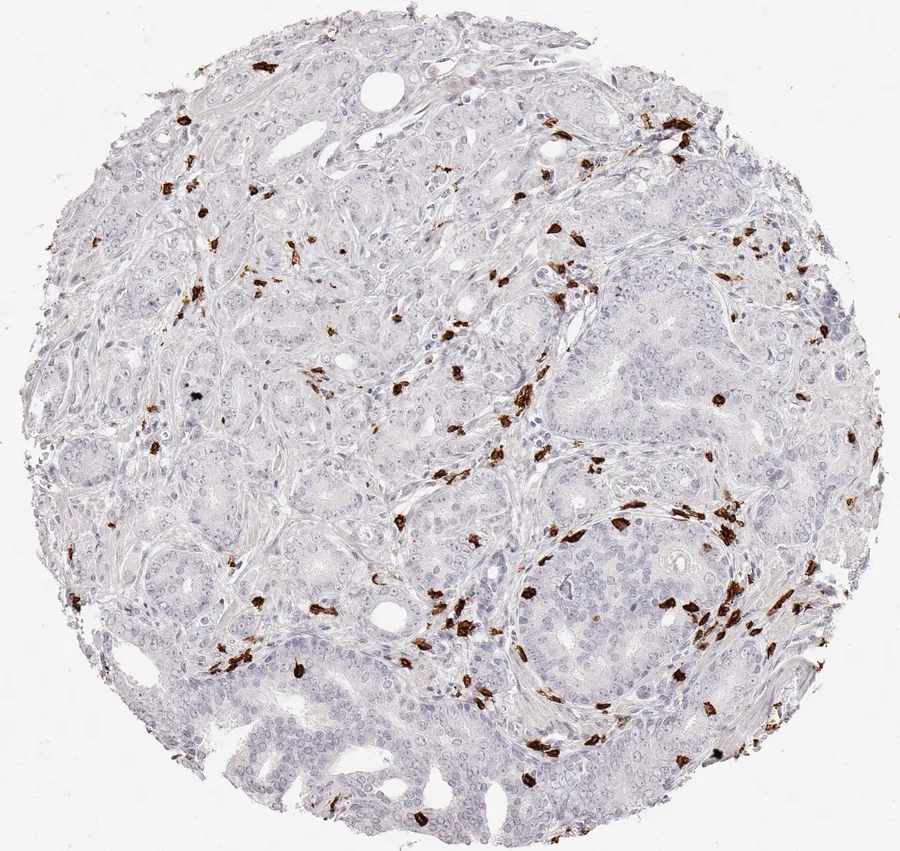 Immunohistochemistry of human CD8 with anti-CD8 clone TC8 (DIA-TC8) in FFPE tissue – dense infiltrate of CD8-positive lymphocytes in adenocarcinoma of the prostate; figure 01 of the previous ONCOdianova CD8 gallery.