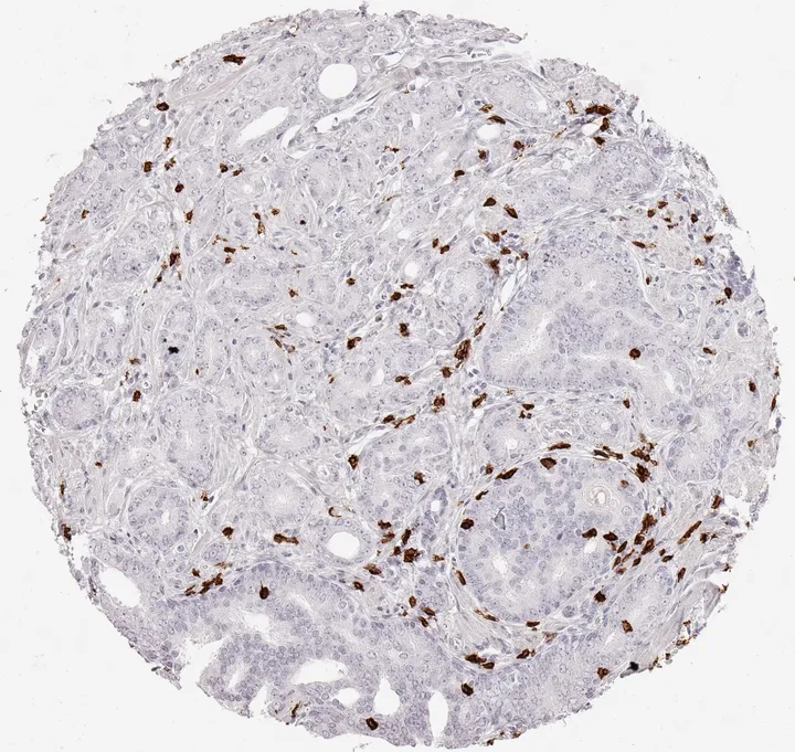 Immunohistochemistry of human CD8 with anti-CD8 clone TC8 (DIA-TC8) in FFPE tissue – dense infiltrate of CD8-positive lymphocytes in adenocarcinoma of the prostate; figure 01 of the previous ONCOdianova CD8 gallery.