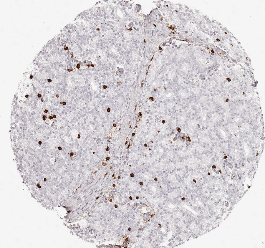 Immunohistochemistry of human CD8 with anti-CD8 clone TC8 (DIA-TC8) in FFPE tissue – infiltrated by CD8-positive lymphocytes in adenocarcinoma of the prostate; figure 02 of the previous ONCOdianova CD8 gallery.