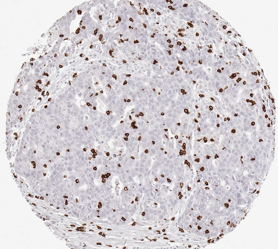 Immunohistochemistry of human CD8 with anti-CD8 clone TC8 (DIA-TC8) in FFPE tissue – dense infiltrate of CD8-positive lymphocytes in serous carcinoma of the ovary; figure 12 of the previous ONCOdianova CD8 gallery.