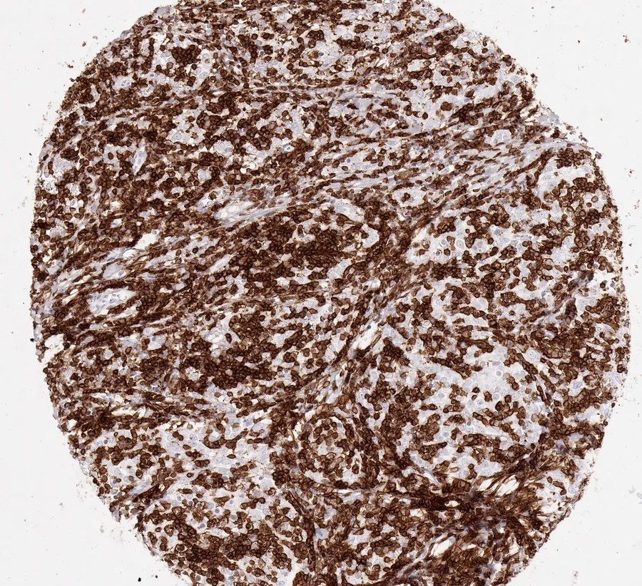 Immunohistochemistry of human CD8 with anti-CD8 clone TC8 (DIA-TC8) in FFPE tissue – CD8-positive lymphocytes in thymoma; figure 35 of the previous ONCOdianova CD8 gallery (tissue designation from the source file name).