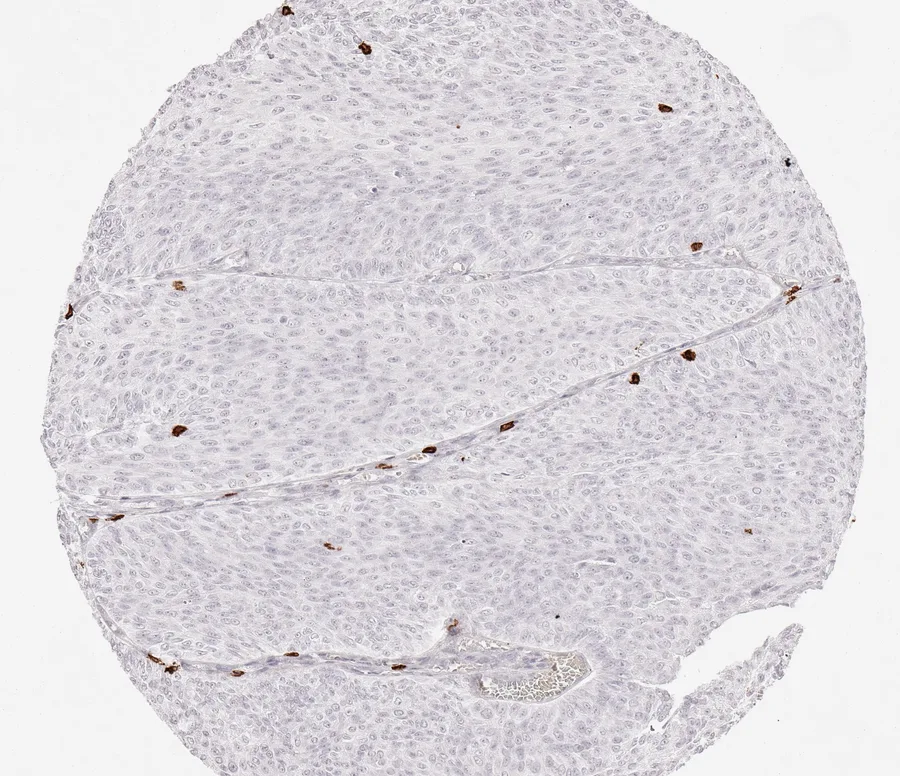 Immunohistochemistry of human CD8 with anti-CD8 clone TC8 (DIA-TC8) in FFPE tissue – some scattered CD8-positive lymphocytes in papillary non-invasive urothelial carcinoma of the urinary bladder; figure 24 of the previous ONCOdianova CD8 gallery.